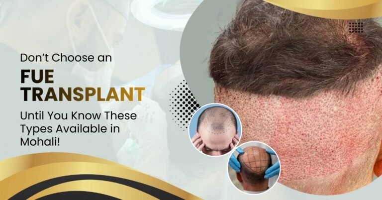 Don’t Choose an FUE Transplant Until You Know These Types Available in Mohali!